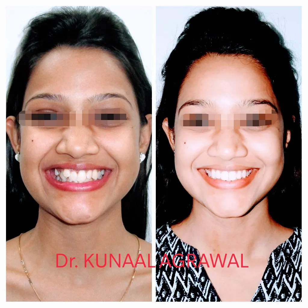 braces before and after bhopal 7